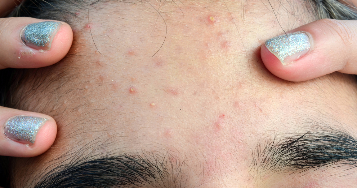 acne treatment, hong kong