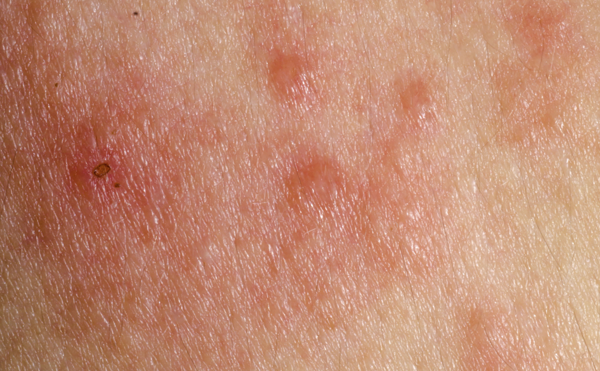 dermatitis treatment hong kong