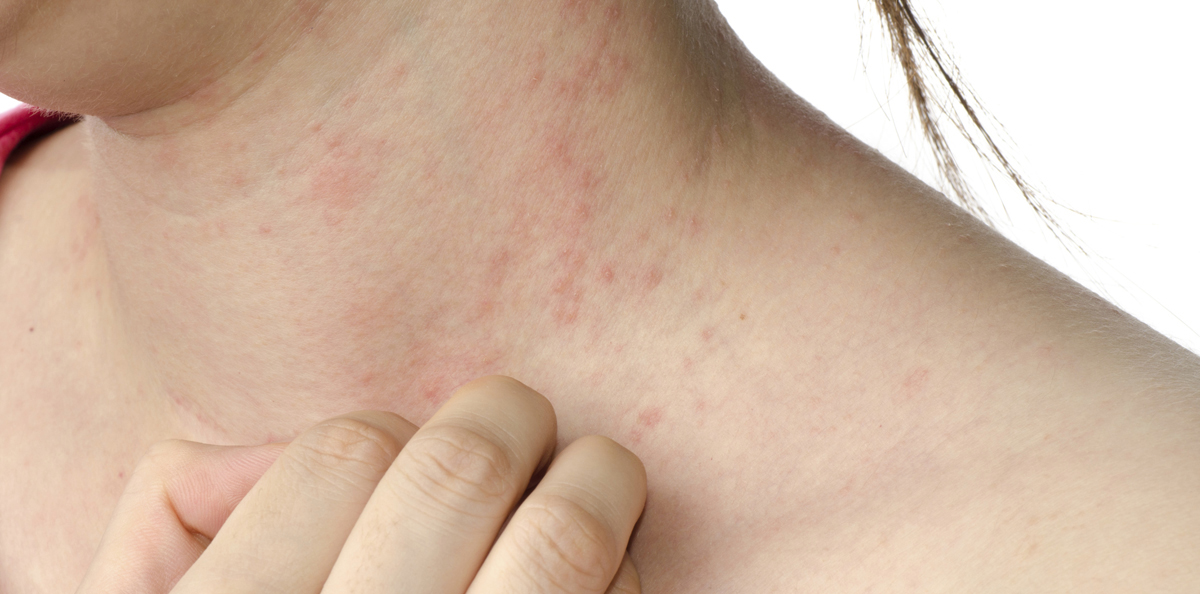 eczema treatment , hong kong, causeway bay 