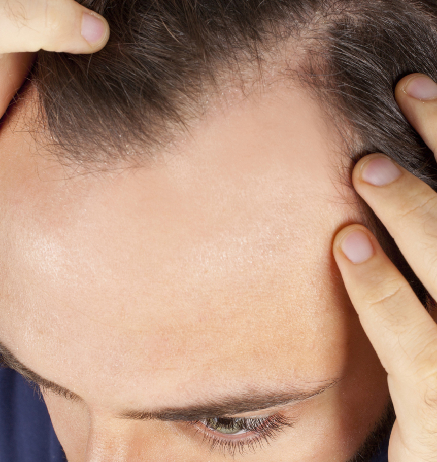 female hairloss, hong kong 